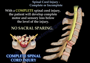 spinal cord injury attorney